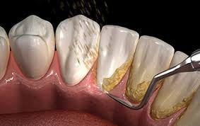 detartrajul cu ultrasunete davinci dental clinic